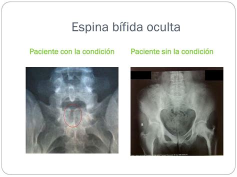 espina bifida oculta en adultos